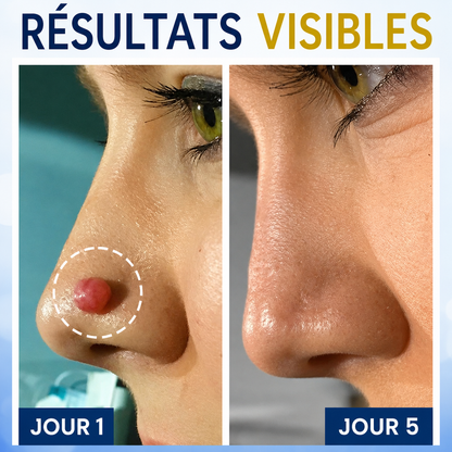 AEXZR® Spray de Traitement par le Froid pour Étiquettes de Peau🧊 Cryo-Tech de Précision : Élimine les grains de beauté et verrues en quelques secondes – Sans lames, sans douleur.